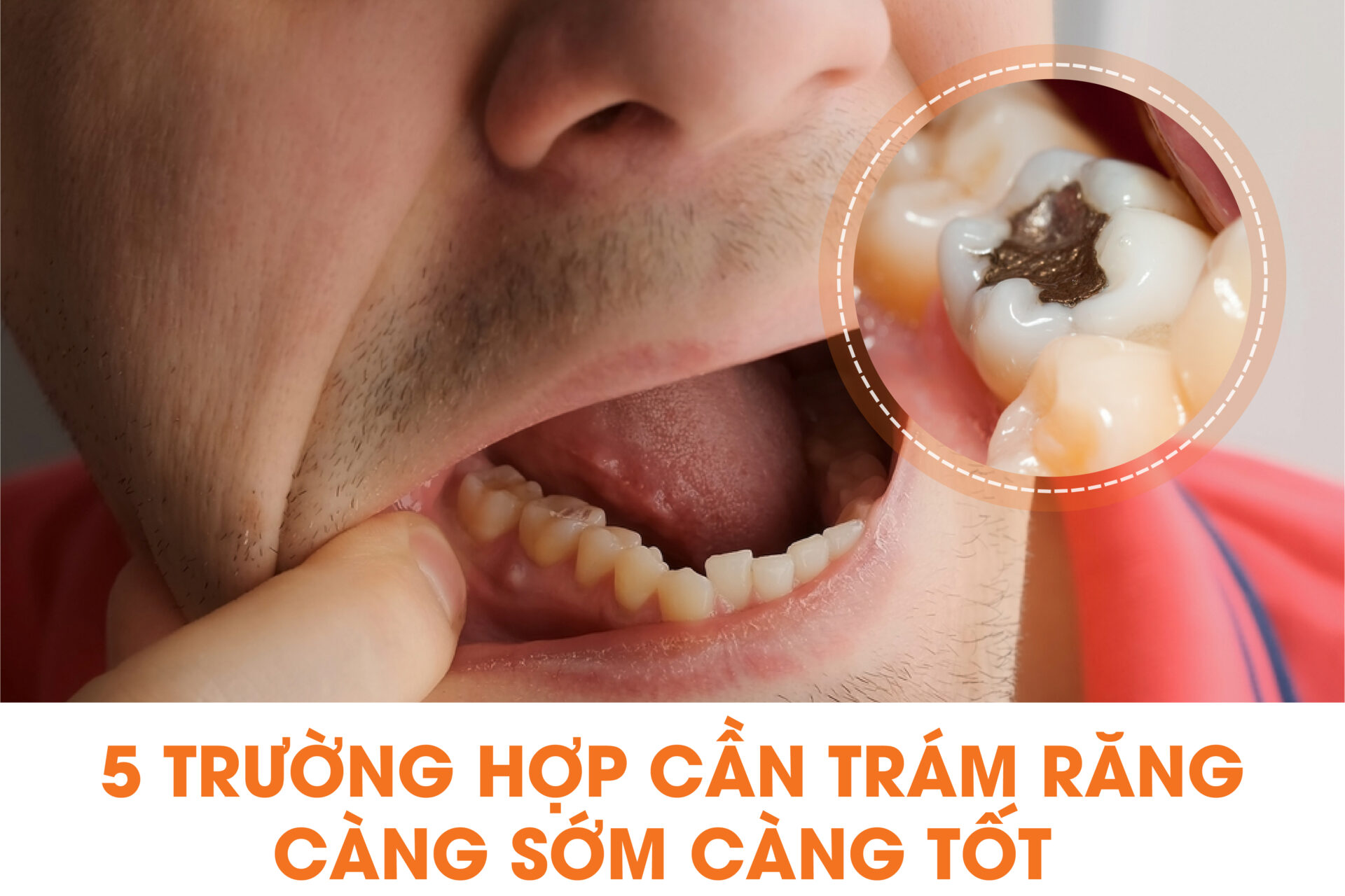 Các Vấn Đề Có Thể Phát Sinh Sau Khi Trám Răng