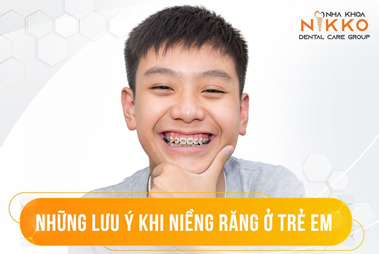 Niềng Răng Cho Trẻ Em