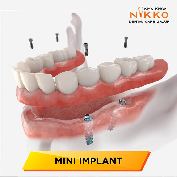 4 phương pháp trồng răng Implant ứng dụng phổ biến trên thị trường