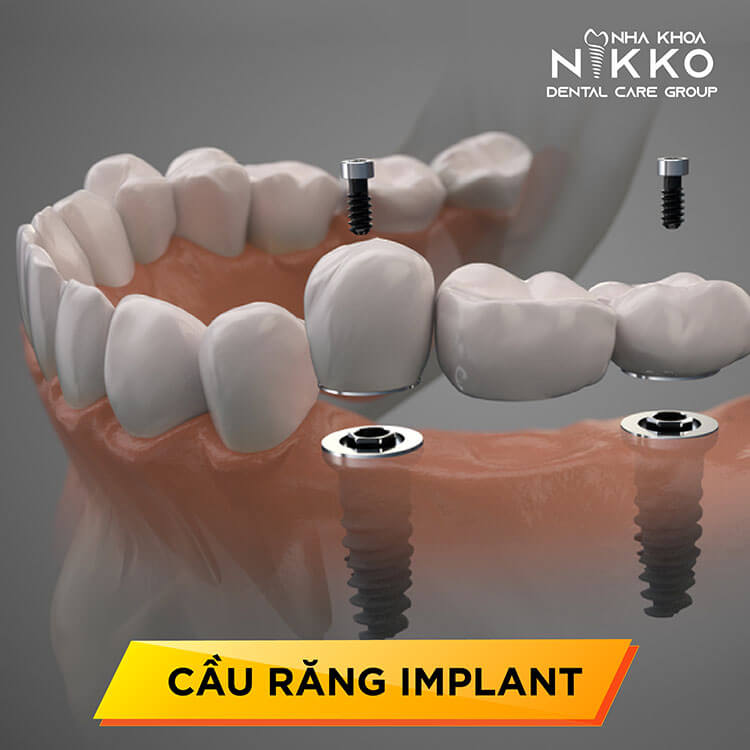 4 phương pháp trồng răng Implant ứng dụng phổ biến trên thị trường