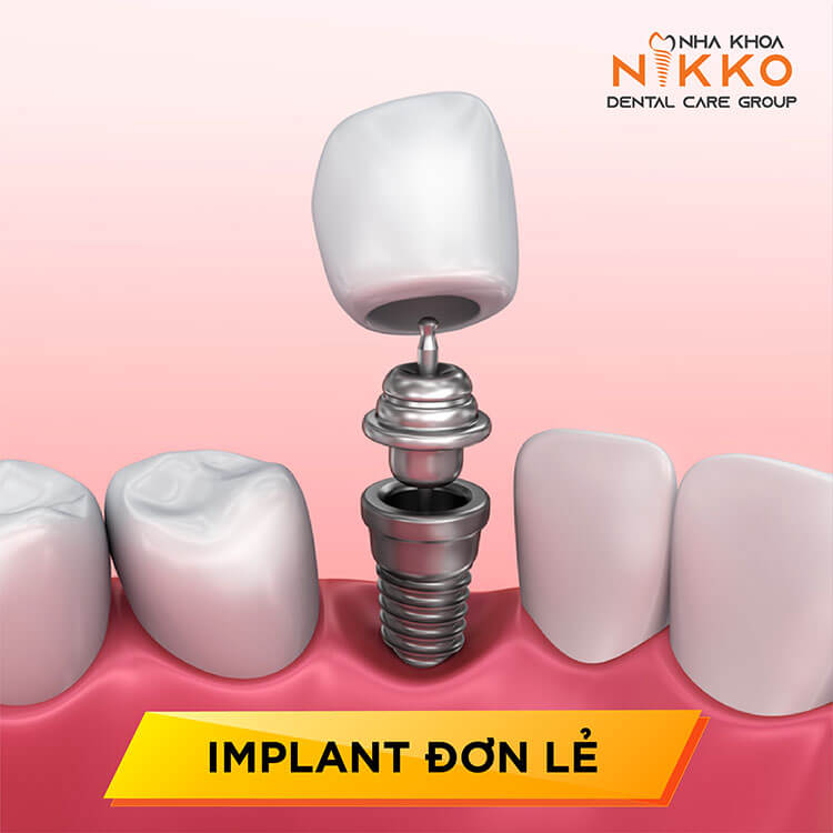 4 phương pháp trồng răng Implant ứng dụng phổ biến trên thị trường