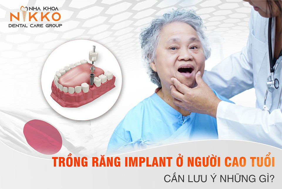 Trồng Răng Implant ở người cao tuổi cần lưu ý những gì?